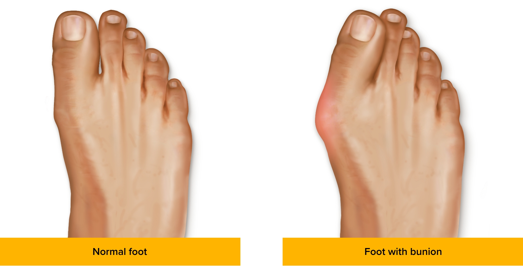 Normal Foot vs Foot with Bunion Infographic